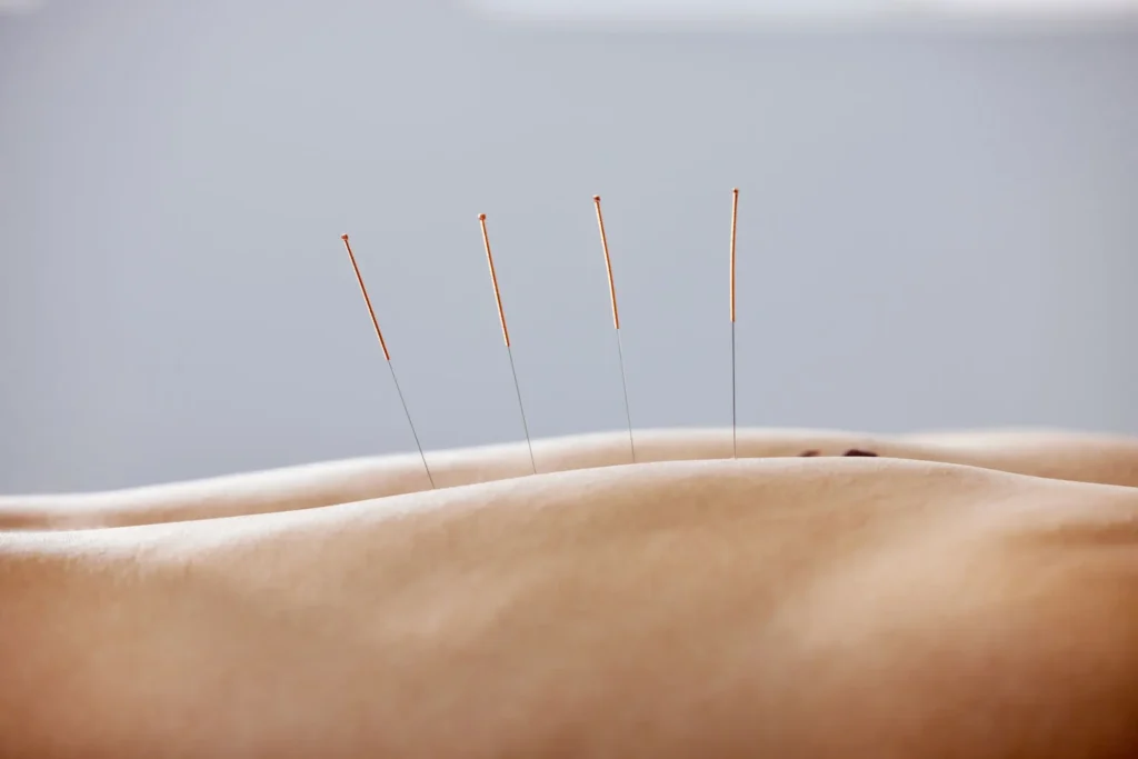 licensed acupuncturist in Edmonton placing sterile acupuncture needles safely