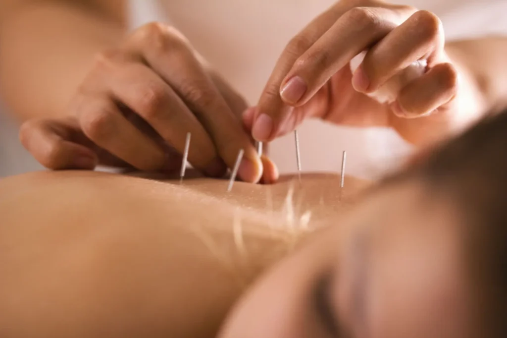 Edmonton acupuncturist creating a personalized acupuncture session plan