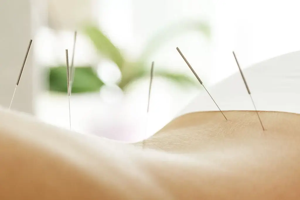 Acupuncture needles placed in a patient’s back during an acupuncture session