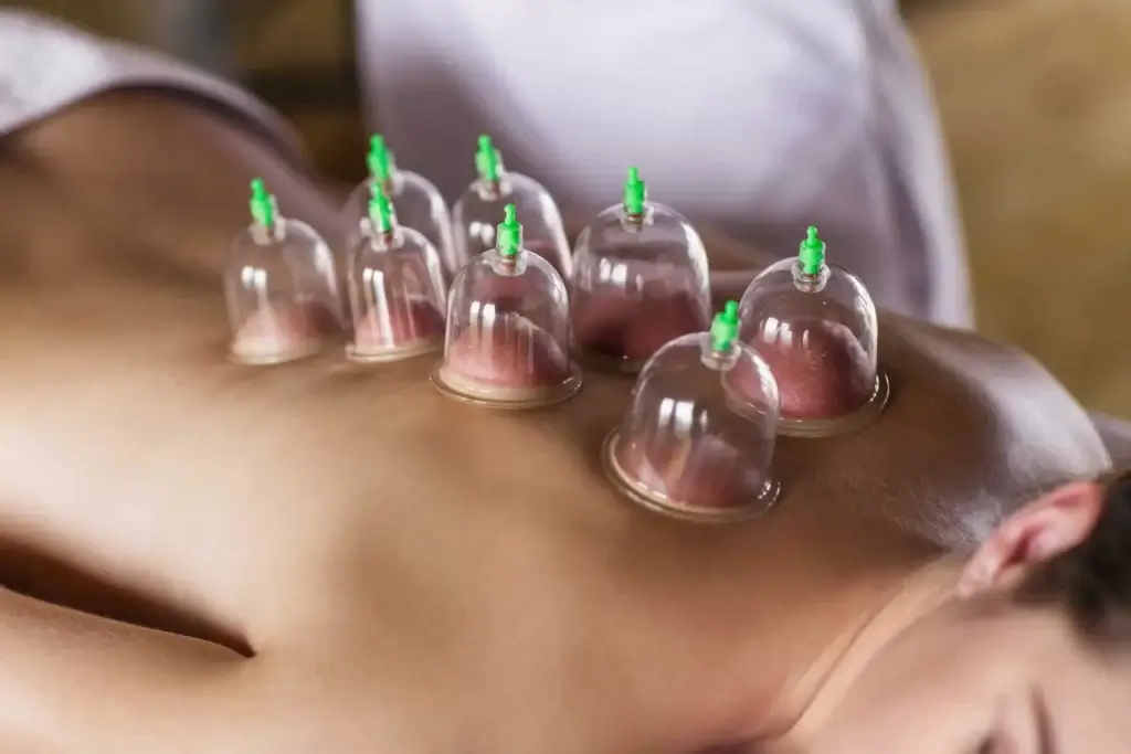 cupping therapy session