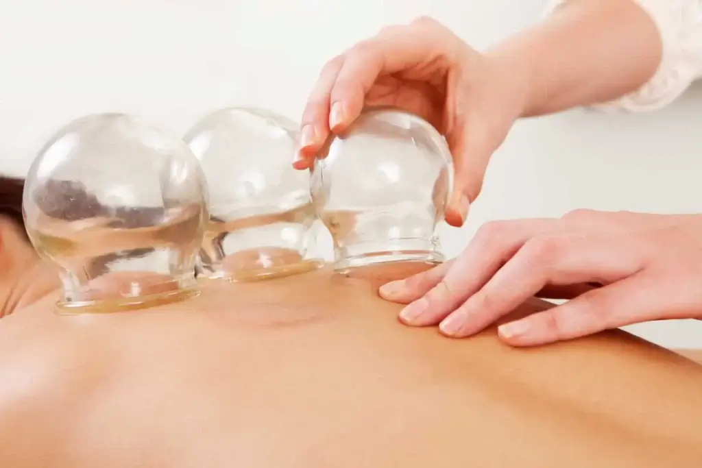 Edmonton cupping therapy