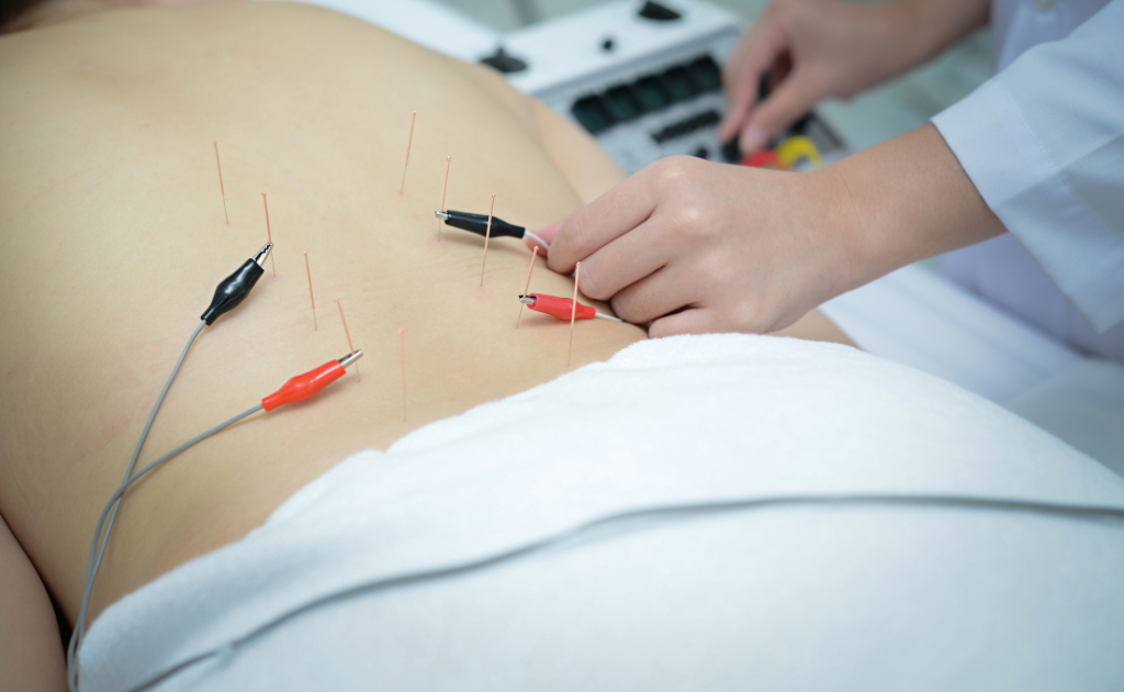 Electro Acupuncture in Edmonton