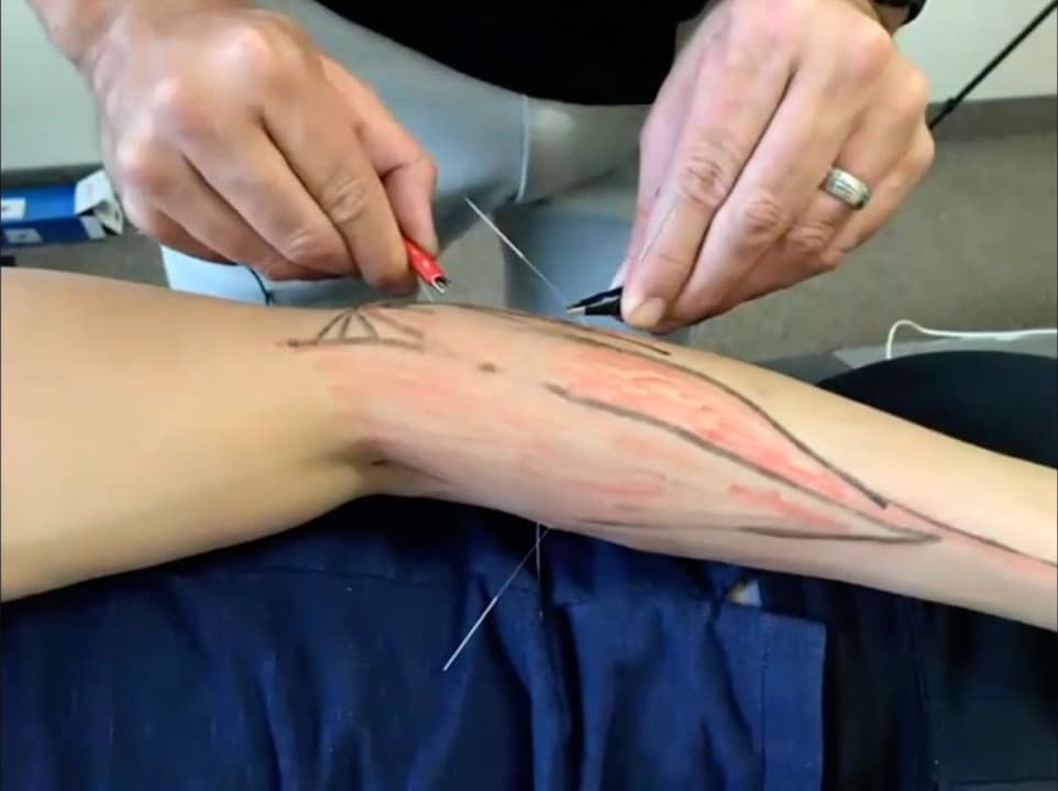 EXSTORE technique on carpal tunnel