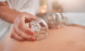Cupping therapy and acupuncture treatments used for pain relief and circulation