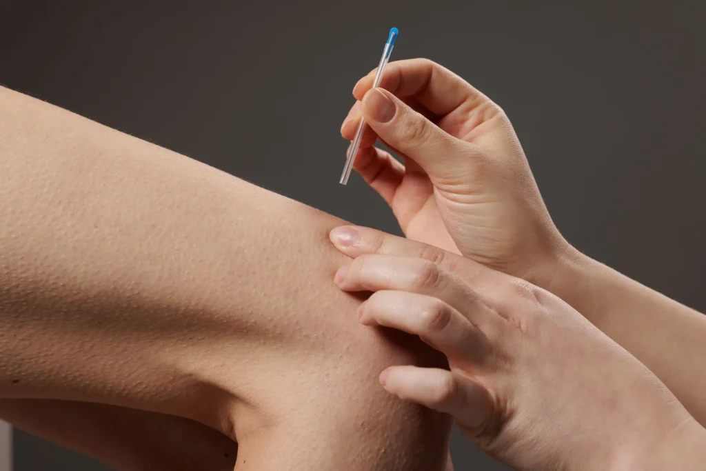 electro acupuncture treatment with electrical leads connected to acupuncture needles