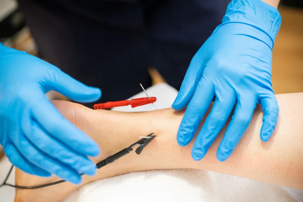 comparison of motor point acupuncture and electro acupuncture treatment techniques